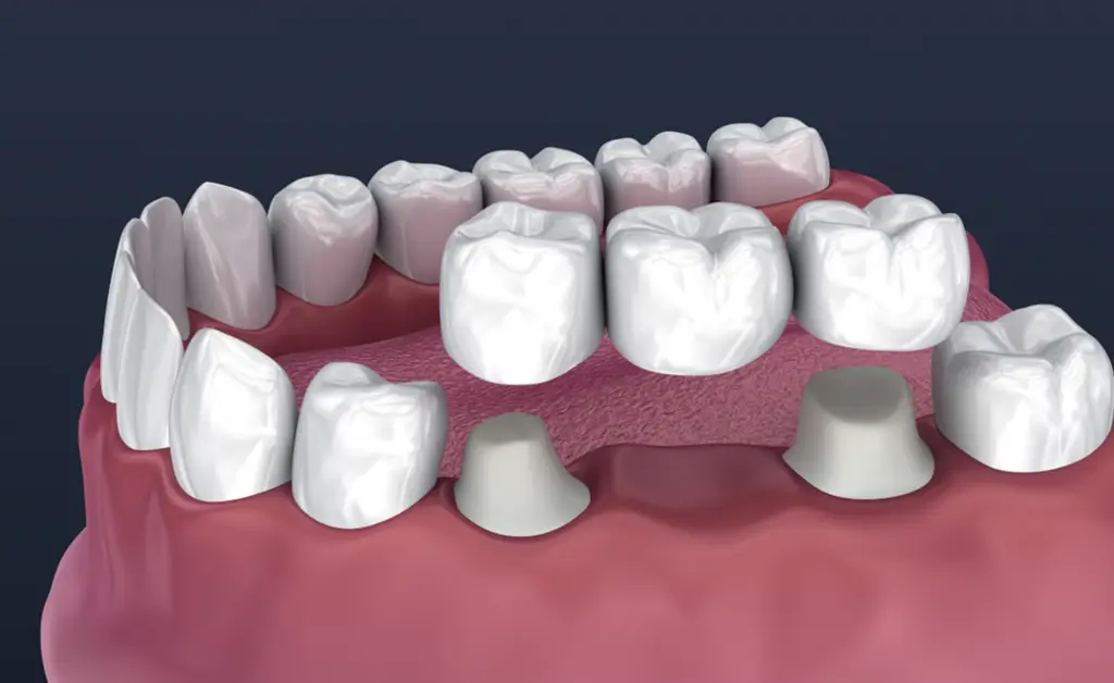 Crown Lengthening