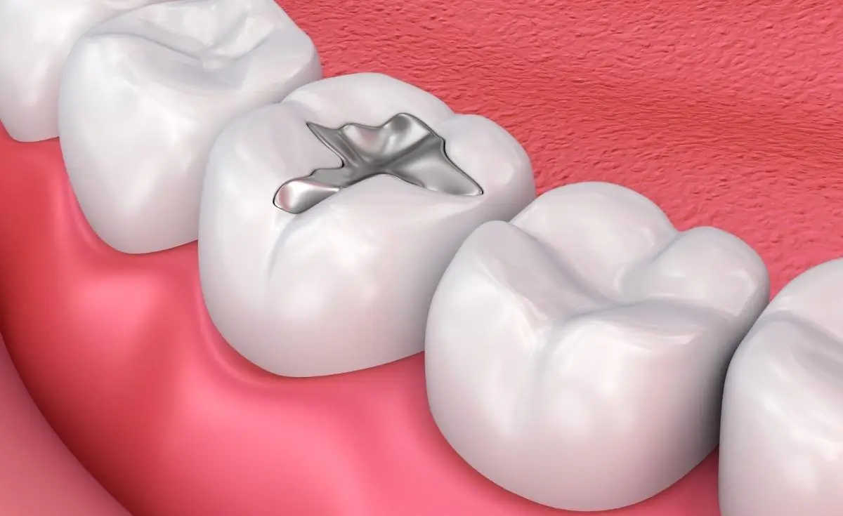 Fillings
