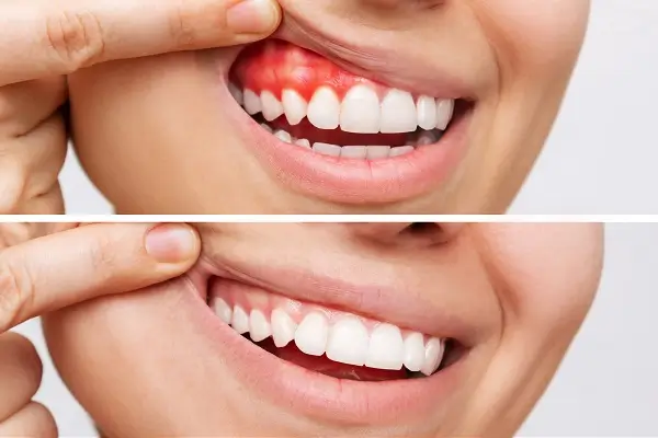 laser gum surgery